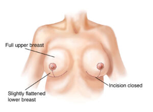 Inverted t breast lift esprit® cosmetic surgeons