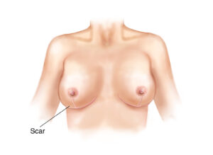 Vertical breast lift esprit® cosmetic surgeons